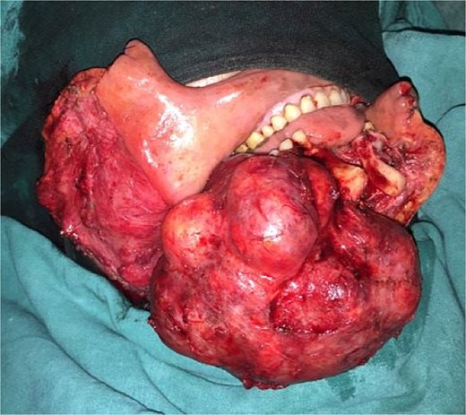 Intraoperative photograph showing the resected mandibular segment with a well-circumscribed lesion.