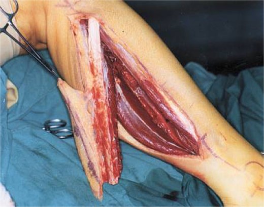 Harvested free fibula flap with the vascular pedicle visible.