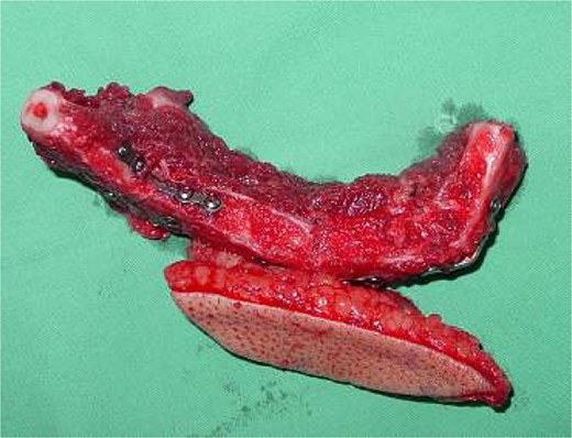 Contoured fibula flap with a skin paddle, multiple osteotomies, and miniplate fixation.