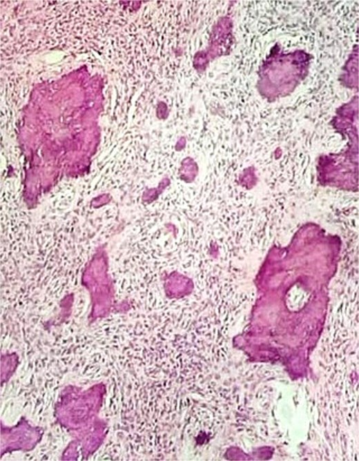 Histopathological findings showing cellular fibrous stroma with woven bone trabeculae.