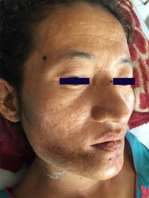 Postoperative photograph at day 10 showing restored facial symmetry with minimal scarring after suture removal.