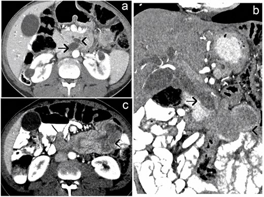 Axial and coronal CT images showing displacement of the common bile duct and pancreatic duct, along with duodenal intussusception. In (a), axial CT demonstrates medial displacement of the common bile duct and main pancreatic duct. In (b), coronal CT shows medial displacement of the common bile duct and evidence of duodenal intussusception. In (c), axial CT highlights duodenal intussusception.