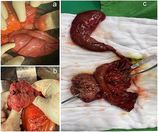 Three clinical images related to duodeno-jejunal intussusception and ampullary pathology. In (a), an image shows duodeno-jejunal intussusception. In (b), an ampullary tumor is visible with bile draining from it, indicated by an arrowhead. In (c), a surgical specimen following pancreaticoduodenectomy is shown, with forceps inserted through the common bile duct exiting at the ampulla, and a curved hemostat indicating the pancreatic duct.