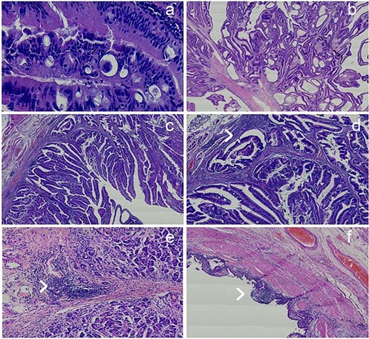 Histopathological hematoxylin and eosin-stained sections showing multiple tissue findings. (a) Cribriform glandular structures lined by pseudostratified tall columnar cells with elongated, hyperchromatic, enlarged, pleomorphic nuclei. (b) Pedunculated polyp consistent with tubulovillous adenoma. (c) Abnormal villous architecture with back-to-back gland formation, prominent glandular budding, intraluminal papillary tufting, and invasion into the muscularis mucosa. (d) Atypical glandular invasion into the muscularis mucosa indicated by an arrowhead. (e) Pancreatic tissue showing benign acini with marked fibrosis and lymphocytic inflammatory infiltrates indicated by an arrowhead. (f) Gallbladder mucosa showing erosion and marked lymphocytic inflammatory infiltrates indicated by an arrowhead.