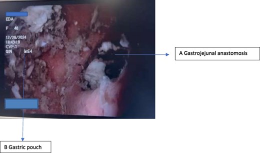 Endoscopic view of the coconut bezoar located within the gastric pouch.