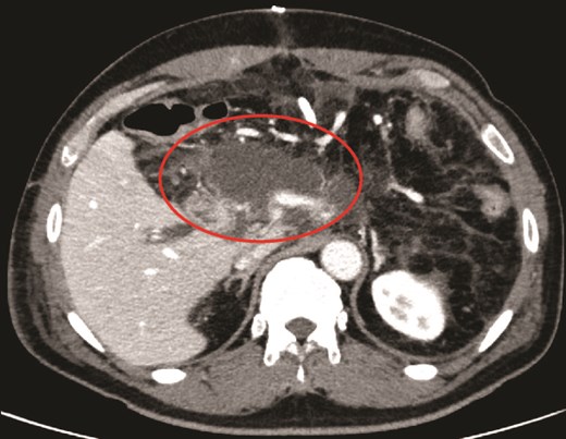 Contrast-enhanced CT image showing a localized fluid collection around the pancreatic stump.