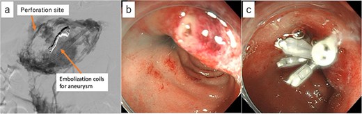Fluoroscopic images show contrast leakage indicating a duodenal perforation and the placement of embolization coils in the GDA. Endoscopic images identify the perforation site and show clipping performed to close the perforation.