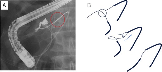 Fluoroscopic images show a guidewire inserted via an endoscope from the Vater papilla being captured and guided using a Goose Neck snare introduced from the drainage side. A schematic illustration depicts the pull-through technique in three sequential steps.