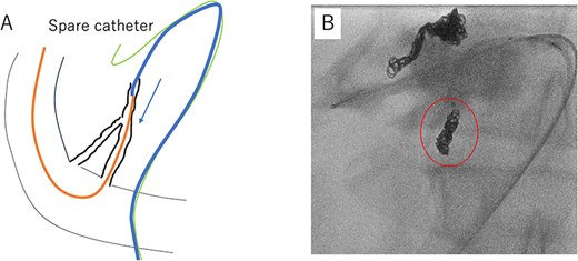 A schematic illustration shows a catheter connected using the pull-through method to guide an embolization catheter. Fluoroscopic images show the placement of vascular embolization coils.