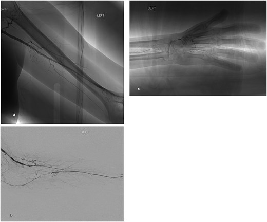 (a) X-ray arteriogram of the left arm showing contrastfilled arteries. The distal brachial artery appears abruptly narrowed and blocked, with reduced blood flow beyond the occlusion and smaller collateral vessels visible around the elbow region. (b) X-ray arteriogram of the left forearm showing blocked proximal radial and ulnar arteries. A single interosseous artery remains open, carrying contrast distally and supplying the forearm through smaller branching vessels. (c) X-ray arteriogram of the left hand showing multiple occluded vessels with limited contrast flow. A connection between the distal radial artery and the interosseous artery provides partial blood supply to the hand through faint collateral channels.