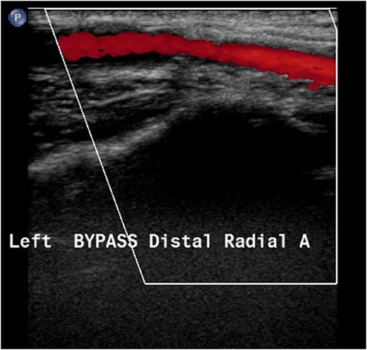 Duplex ultrasound image of the left forearm with a color Doppler overlay (red) showing blood flow through a bypass graft, demonstrating a patent graft with continuous flow.
