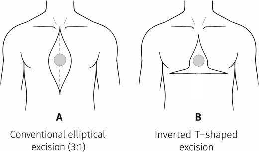 Schematic comparison between a conventional elliptical excision and an inverted T-shaped excision for midline anterior chest wall skin tumors.