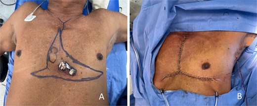 Preoperative and immediate postoperative views of a midline anterior chest wall melanoma treated with an inverted T-shaped excision and primary closure.