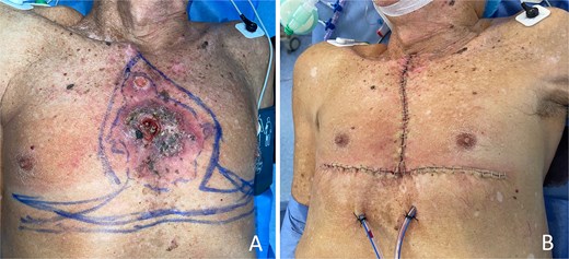 Preoperative and immediate postoperative views of an extensive midline anterior chest wall squamous cell carcinoma treated with an inverted T-shaped excision and primary closure.
