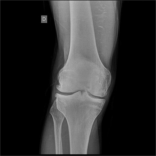 Frontal X- ray of a right knee displaying narrowed joint space, bone spurs, and increased bone density below the cartilage.