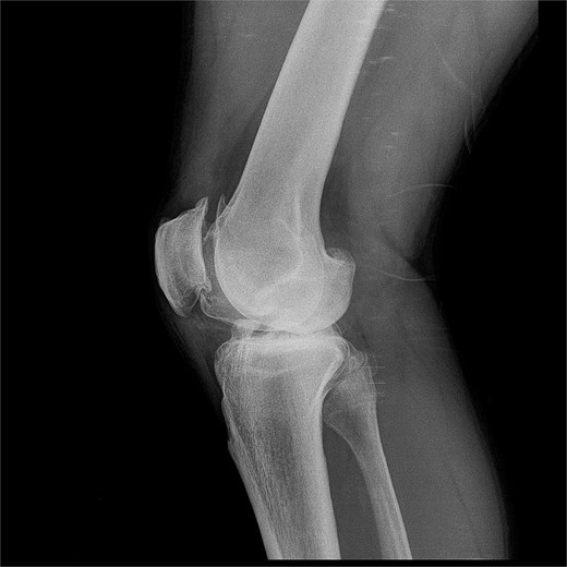 Lateral X.ray of the right knee showing significant structural changes and joint involvment.