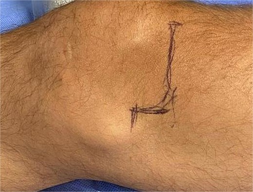 Clinical photograph showing the surgical incision marking on the skin of a right knee.