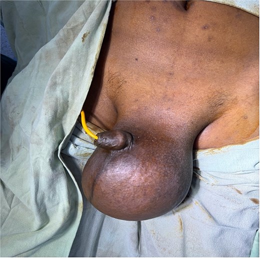 Preoperative clinical photograph of the scrotum showing marked enlargement of the left hemiscrotum caused by a large soft swelling consistent with hydrocele, resulting in visible asymmetry compared with the normal right side.