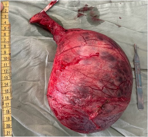 Gross surgical specimen following left high inguinal orchidectomy showing a markedly enlarged testicular mass with smooth external surface and distorted testicular anatomy, consistent with giant seminoma.