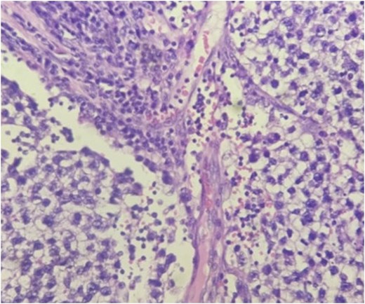 Histopathological photomicrograph showing classical seminoma composed of large uniform tumor cells arranged in sheets and lobules, separated by fibrous septae containing dense lymphocytic infiltrates.