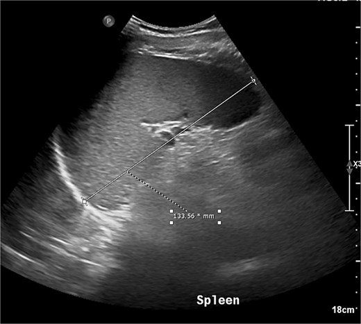 Grey scale ultrasound examination of the abdomen showed a mildly enlarged spleen (Asterix).