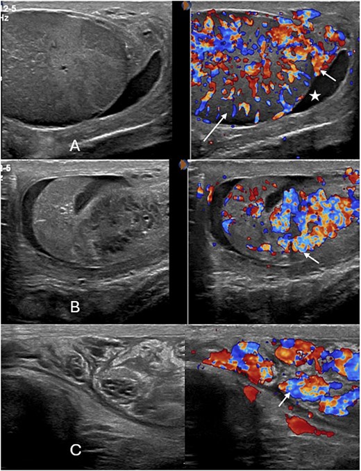 Follow up color doppler examination of the scrotum reveals progressively enlarged epididymis (short arrow in A and B) and testis (long arrow in A) with increased vascularity along with mild hydrocele (Asterix in A). At a superior level, the spermatic cord also shows progressive thickening and increased vascularity (short arrow in C).