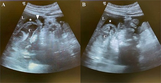 Two side-by-side ultrasound images of the right upper abdomen. Both images show a dark, anechoic fluid collection between the liver and kidney. A cystic structure with a wavy internal membrane is visible below the liver. In the left image, curved tubular structures representing loops of small bowel float within the dark fluid.