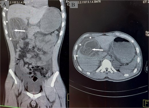 Two CT scan images of the abdomen. The left image is a vertical coronal view showing a cystic cavity in the liver with a white wavy membrane inside. Dark fluid extends upward beneath the diaphragm. The right image is a horizontal axial view showing the same cystic cavity in the liver with a floating wavy membrane. Dark fluid surrounds the liver.