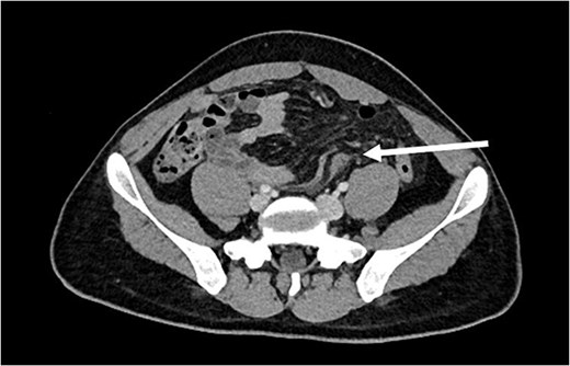 Axial contrast-enhanced CT scan demonstrating a thick fibrous band adjacent to the iliac vessels (arrow).