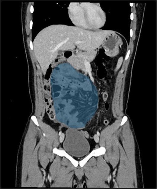 Coronal contrast-enhanced CT image demonstrating clustered small bowel loops within the right hemiabdomen with lateral displacement of the superior mesenteric vessels toward the left side.
