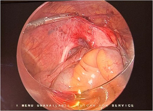 Laparoscopic intraoperative image demonstrating a long, thick peritoneal band overlying the iliac vessels and extending cranially toward the mesenteric root, beneath which small bowel loops were herniated.