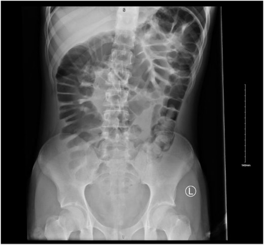 Plain abdominal radiograph demonstrating gaseous distension of the colon with faecal loading predominantly in the sigmoid colon, without evidence of free intraperitoneal air.