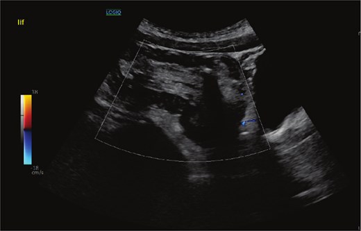 Abdominal ultrasound image demonstrating a left iliac fossa mass with appearances suggestive of colo-colic intussusception, showing concentric bowel loops consistent with bowel telescoping.