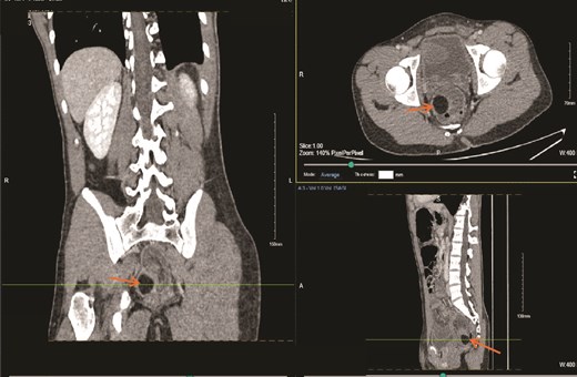 Contrast-enhanced CT scan of the abdomen demonstrating a sigmoid colo-colic intussusception with a well-defined fat-density submucosal lesion acting as the lead point, consistent with a colonic lipoma, with associated free fluid in the pelvis.