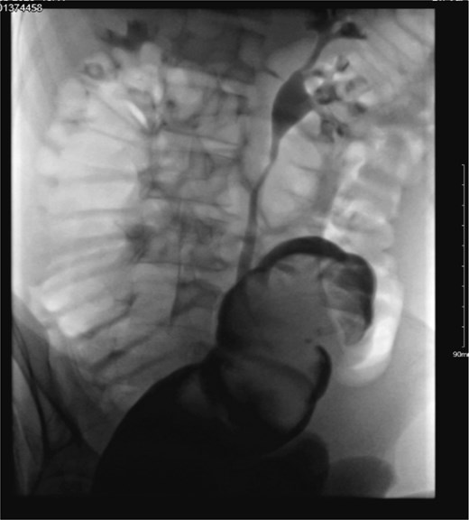 Fluoroscopic urograffin enema image demonstrating contrast within the colon with persistent obstruction and failure of reduction of the sigmoid colo-colic intussusception during attempted non-operative decompression.