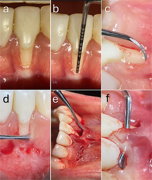 Six sequential intraoral clinical photographs demonstrating management of a mandibular anterior gingival recession defect using a tunnelling approach. Panels show localized recession with thin gingival tissues and reduced keratinised tissue, periodontal probing without interproximal attachment loss, root surface instrumentation, and preparation of a supraperiosteal tunnel extending beyond the mucogingival junction and beneath adjacent papillae using tunnelling instruments while preserving papillary integrity and vascular supply.