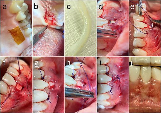 Sequential intraoral clinical photographs demonstrating connective tissue graft harvesting and tunnelling procedure for treatment of mandibular anterior gingival recession. Images show palatal donor site preparation, harvesting and extraoral de-epithelialisation of the connective tissue graft, suture-guided insertion and positioning of the graft within the prepared tunnel, graft stabilisation with tooth-anchored sutures, passive coronal advancement and tension-free flap closure, and postoperative healing at 3 months demonstrating complete root coverage and improved gingival contour.