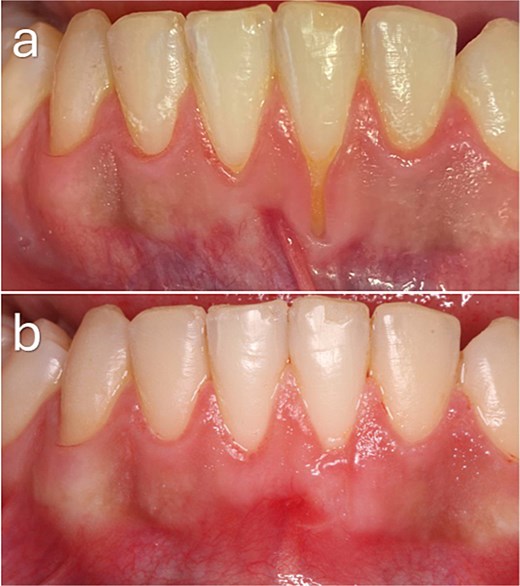 Baseline and 3-month postoperative clinical photographs of a mandibular anterior Cairo RT1 gingival recession defect demonstrating complete root coverage with preservation of the surrounding thick gingival phenotype following treatment.
