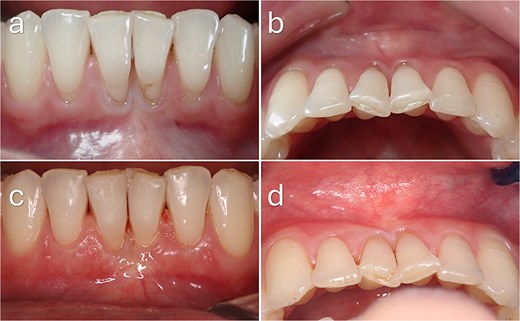 Baseline and 3-month postoperative clinical photographs of mandibular anterior gingival recession defects. Preoperative images show multiple Cairo RT1 and RT2 recession defects associated with a thin periodontal phenotype and limited keratinised tissue. Postoperative images demonstrate complete root coverage at RT1 sites, partial root coverage at RT2 sites, and increased gingival thickness with improved soft tissue contour following mucogingival surgery.