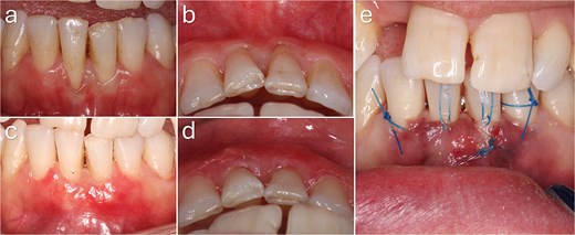 Baseline, intraoperative, and 3-month postoperative clinical photographs of mandibular anterior Cairo RT2 gingival recession defects. Preoperative images show recession associated with a thin periodontal phenotype and reduced keratinised tissue. Postoperative images demonstrate complete root coverage with increased gingival thickness and improved soft tissue contour. The intraoperative image shows interdental papillary extension with lingual release and stabilising sutures to improve flap mobility and coronal advancement.