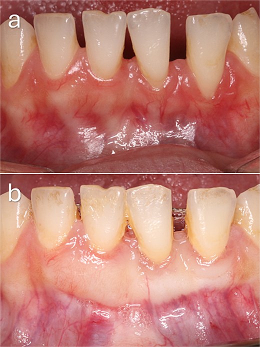Baseline and 3-month postoperative clinical photographs of mandibular anterior gingival recession defects treated with a modified coronally advanced tunnel procedure. The preoperative image shows recession associated with a thin periodontal phenotype, deep vestibule, incisal attrition, and spacing between the mandibular incisors. The postoperative image demonstrates complete root coverage with increased gingival thickness and improved soft tissue contour.