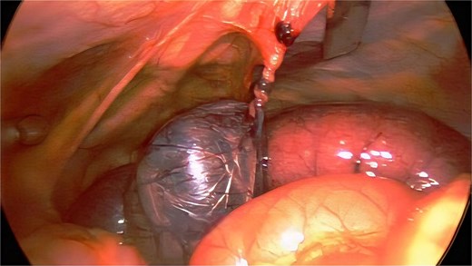 Laparoscopic image showing ischemic, volvulized Meckel diverticulum with adjacent distal ileum tethered to the anterior abdominal wall by a fibrous omphalomesenteric duct remnant, consistent with closed-loop small bowel obstruction.