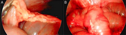 Laparoscopic re-exploration images showing an omental adhesion band constricting the ileum just proximal to the anastomosis, followed by an intact and patent side-to-side small-bowel anastomosis after adhesiolysis.