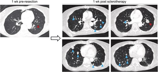 CT images of patient chest demonstrating progression of a solitary metastatic deposit prior to re-resection, progressing to many metastatic lesions with significant interval increase of the original met one week after sclerotherapy.