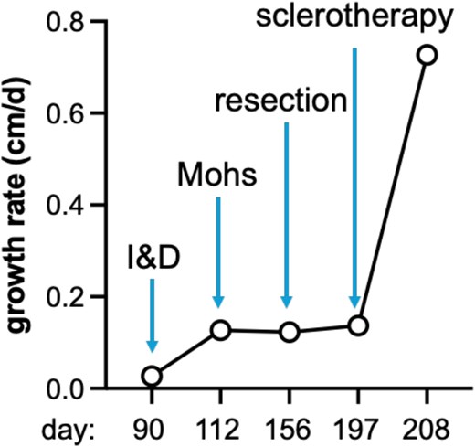 Plot of growth rate (cm per day) over time (days). Growth rate of patient's tumor significantly increased after interventions that left gross disease in situ--I&D and sclerotherapy.