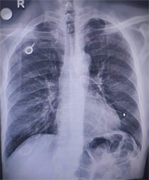 Chest radiograph showing complete migration of a fractured port catheter into the left main and lower lobe pulmonary arteries, consistent with Grade 3 pinch-off syndrome.