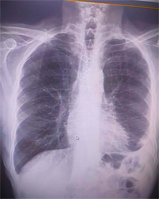 Postoperative chest radiograph following successful surgical removal of the migrated catheter and coronary artery bypass grafting, showing no residual foreign material.