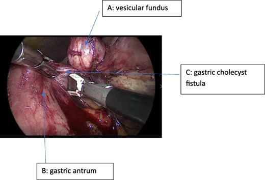 Intraoperative view showing the gallbladder fundus, the cholecystogastric fistula (CGF), and the gastric antrum.