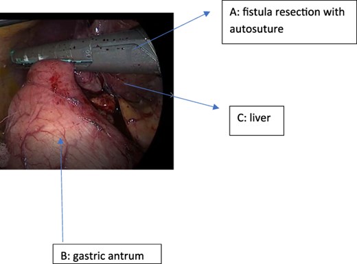 Resection of the cholecystogastric fistula using a 60 mm green-load linear endostapler.