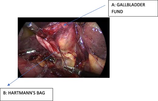 Intraoperative view after fistula resection, showing the gallbladder fundus and Hartmann's pouch.